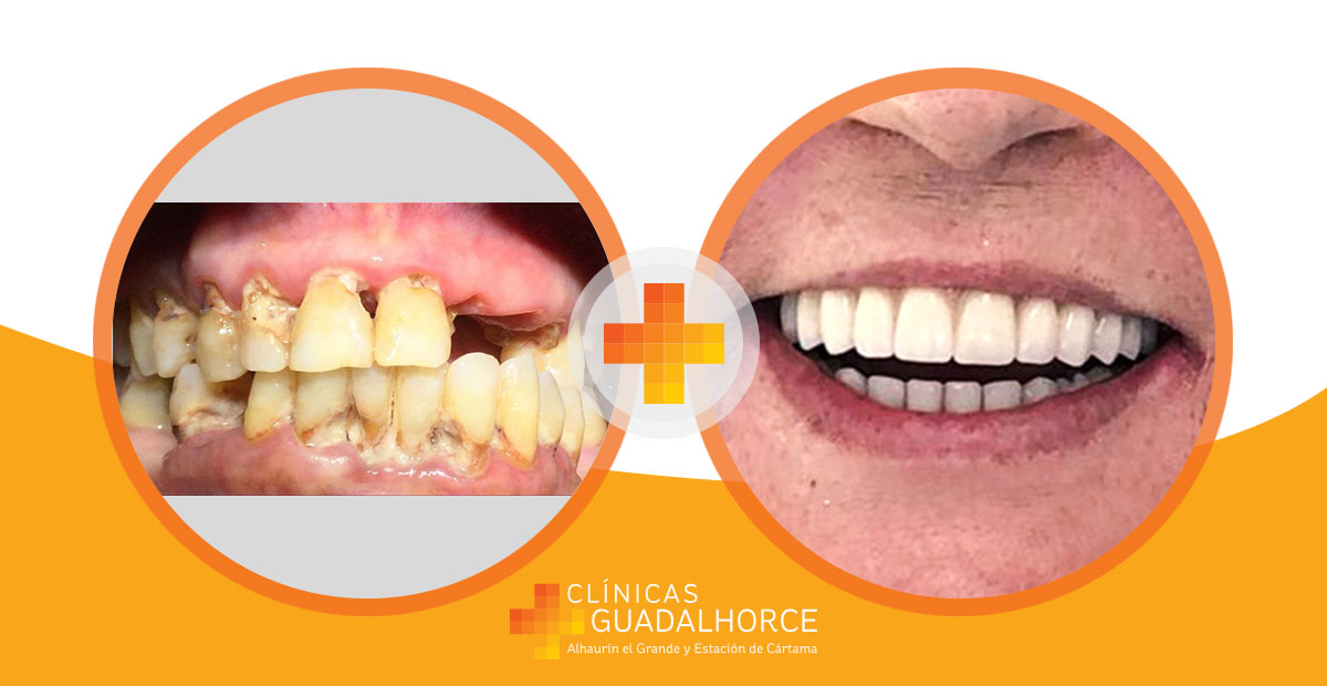 👉 Os mostramos el #AntesyDespués de una recuperación #dental completa de la arcada superior e inferior con #ImplantesDentales 🦷👏

✨ Recupera la sonrisa en Clínicas Guadalhorce 😁🤩
Conoce más ➡️ clinicasguadalhorce.com/clinica-dental…

#Sonrie #clinicadental #malaga