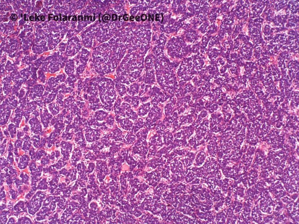 1/2 A male in his 20s with huge intrathoracic mass. Duration: 2 years  #BSTpath Kindly share your thoughts No IHC done