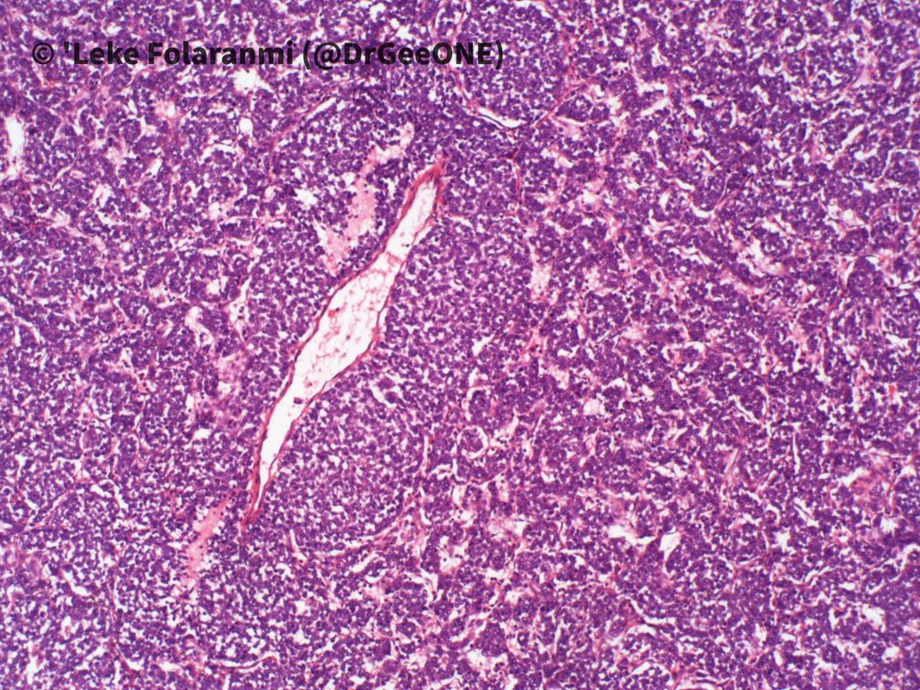 1/2 A male in his 20s with huge intrathoracic mass. Duration: 2 years  #BSTpath Kindly share your thoughts No IHC done