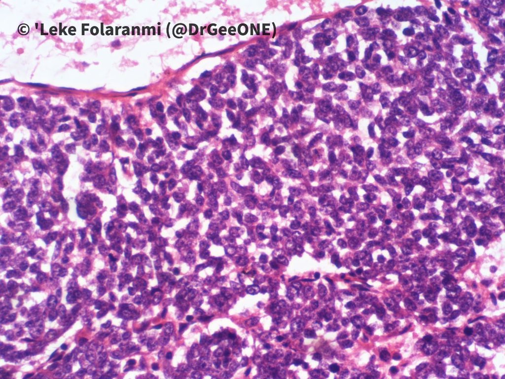 1/2 A male in his 20s with huge intrathoracic mass. Duration: 2 years  #BSTpath Kindly share your thoughts No IHC done