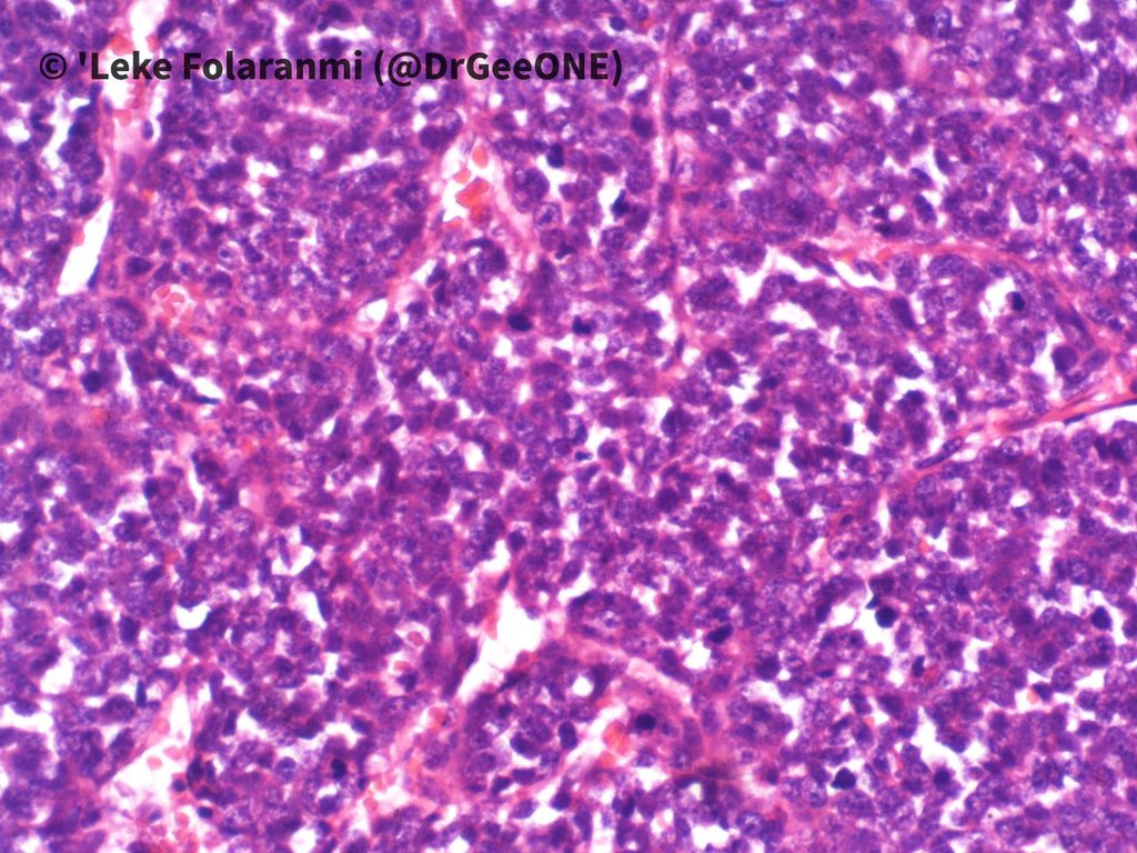 2/2High power pictures of H/E and PAS sections Our list of differentials:-Ewing Sarcoma-DSRCT-Synovial Sarcoma-Mesenchymal chondrosarcoma