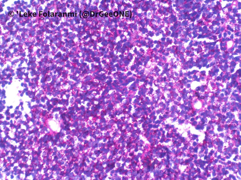 2/2High power pictures of H/E and PAS sections Our list of differentials:-Ewing Sarcoma-DSRCT-Synovial Sarcoma-Mesenchymal chondrosarcoma