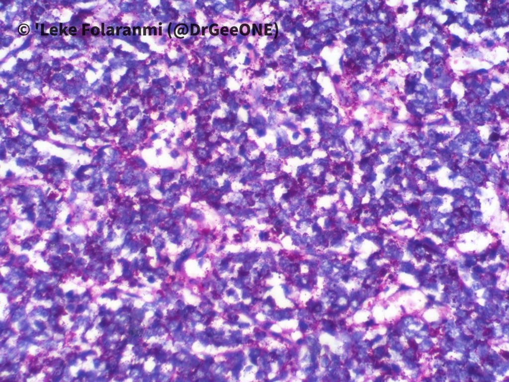 2/2High power pictures of H/E and PAS sections Our list of differentials:-Ewing Sarcoma-DSRCT-Synovial Sarcoma-Mesenchymal chondrosarcoma