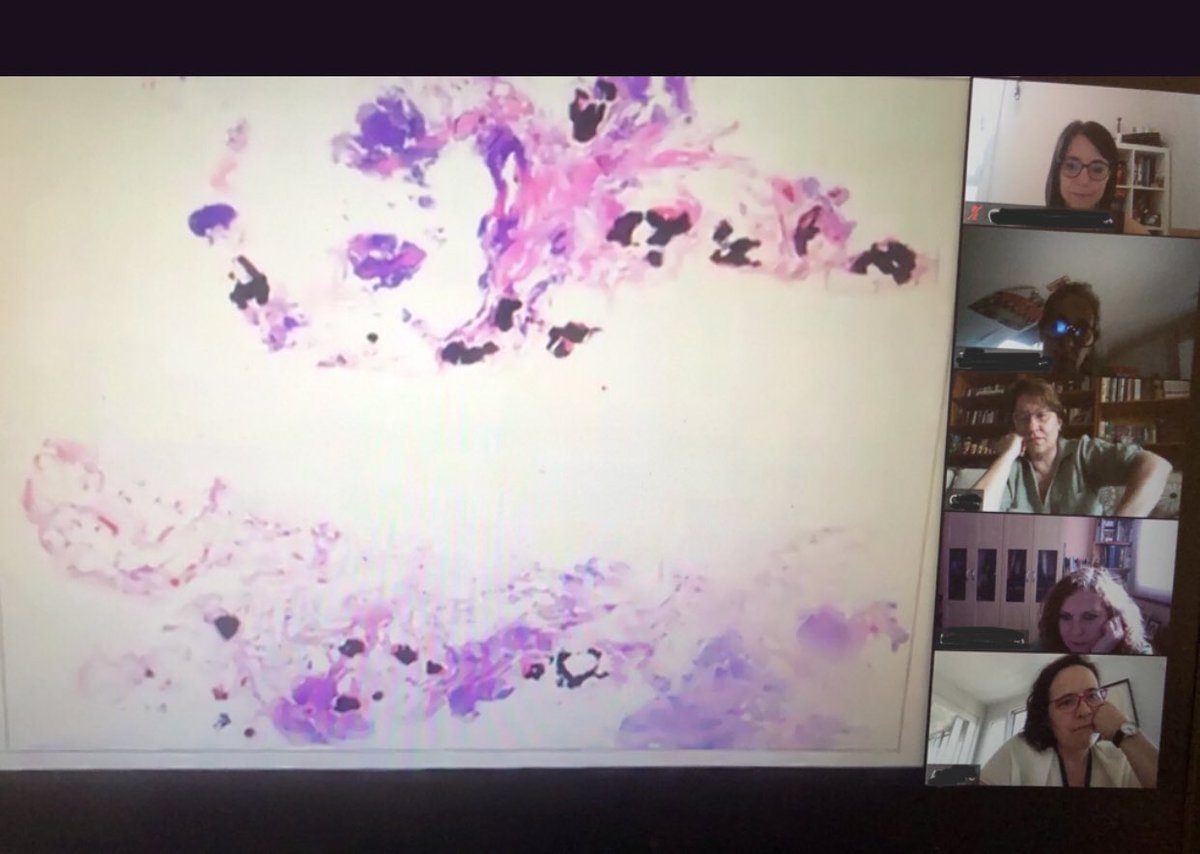 lara_pijuan's tweet photo. @montxa @SansanoValero @smlungpathguy @DrGeeONE @Path_Matt @hskulkarni @yro854 @pathridle_susan @MArnold_PedPath @mreyesm @TheKarenPinto @thoracicpath @AmparoBenito I think we have a Déjà Vu 🤪 (Yesterday Lung Spanish Team in zoom looking very similar cases) 
Let’s see What will be @smlungpathguy case to learn to our cases 🤓 https://t.co/lKyzaENz9j