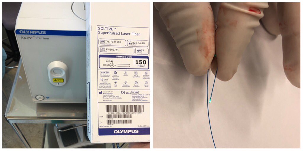Marcin Popiolek (@popiolekmarcin) on Twitter photo Cont. own impressions of SOLTIVE #thuliumfiber: Quite impressed by the 150 micron fiber- Highly flexible- bend radius <5 mm, feels almost like a hair but at the same time more durable than expected <a href="/OlympusUrology/">Olympus Urology Europe</a> Cont. own impressions of SOLTIVE #thuliumfiber: Quite impressed by the 150 micron fiber- Highly flexible- bend radius <5 mm, feels almost like a hair but at the same time more durable than expected <a href="/OlympusUrology/">Olympus Urology Europe</a>