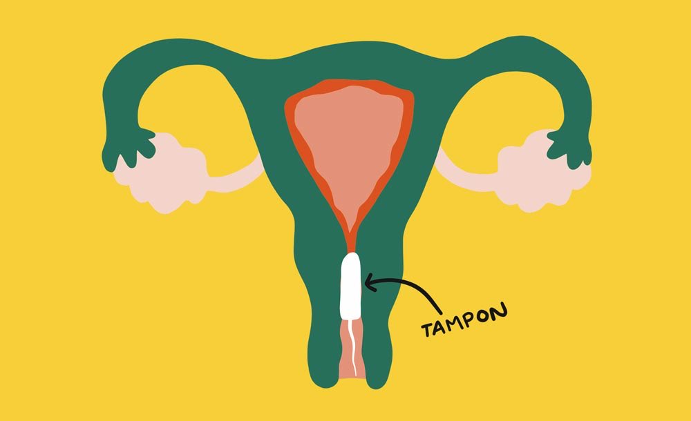 Tampon In Cervix