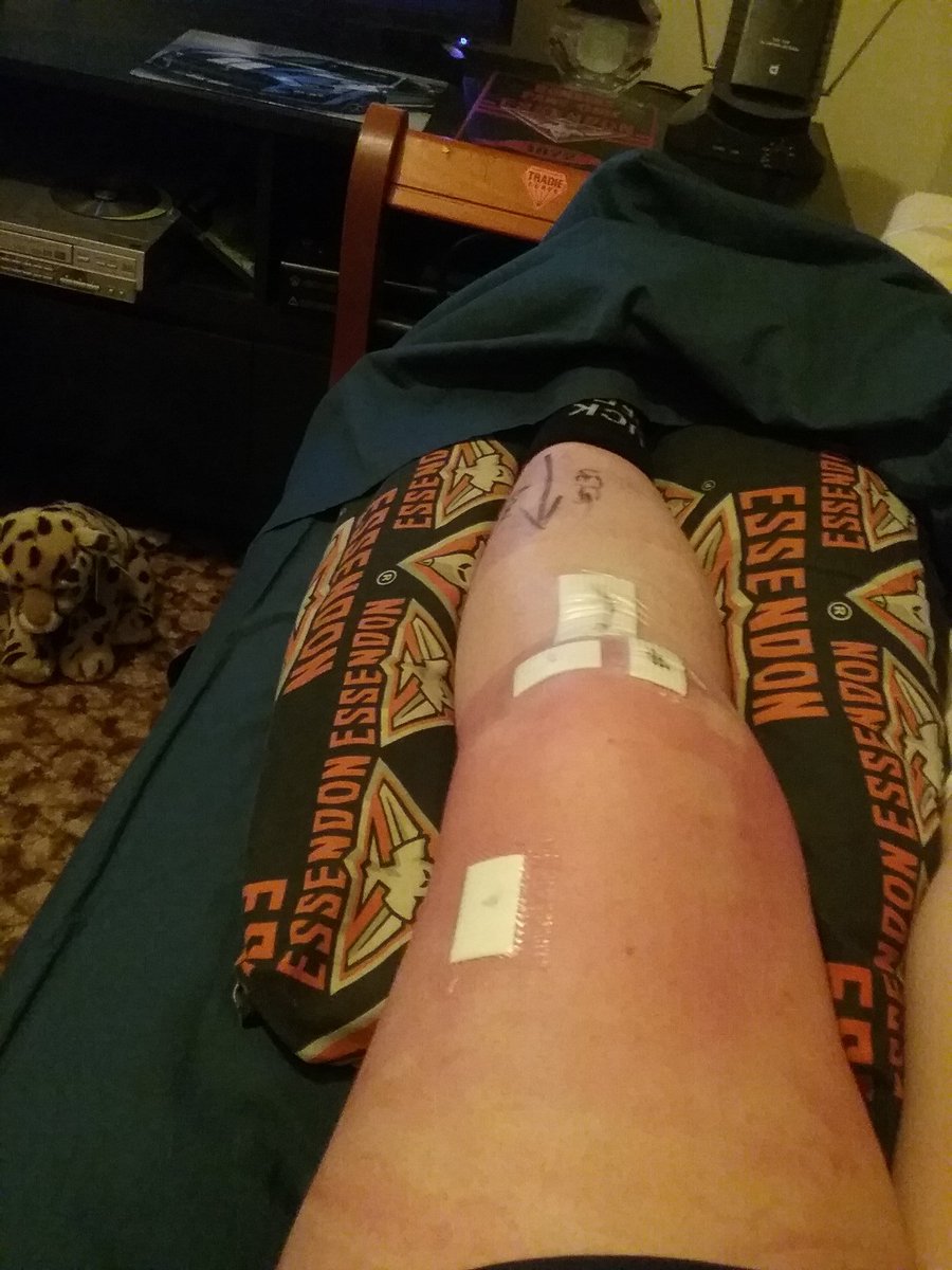 ReggieFletch31's tweet photo. Here's my knee #postaclsurgery (the red tinge is just from the antiseptic) #acl #aclsurgery #sore https://t.co/wzRCla8Sle