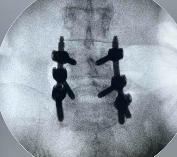 Invimedic's tweet photo. Artrodesis percutánea y descompresión laminar unilateral
👨🏻‍⚕️Dr. Duval Molina
🏨Clínica Santa Margarita
📍Portoviejo
.
#artrodesis #spine #minimamenteinvasivo #minimoinvasivo #trauma #cirugiacolumna #columna #Invimedic https://t.co/Fhzcqtff8I