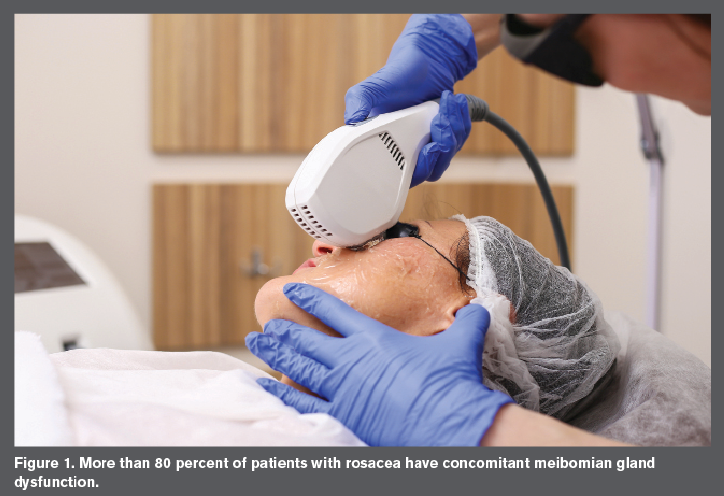 OptometryTimes's tweet photo. IPL treats rosacea and meibomian gland dysfunction. #optometry https://t.co/sN4moUYb9Z https://t.co/IJHIAMS5yd