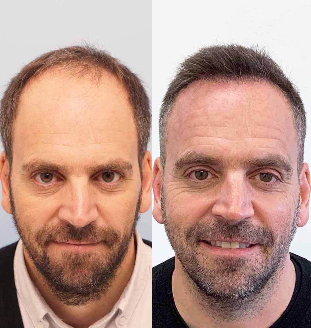 Neil’s #hairtransplant results here are for the front but he also had some in the crown. He had a total of 4855 grafts or about 10,000 hairs

See our website for more details and photos about Neil!

#uk #manchester #london #hairgrowth #hairtransformation #hairloss