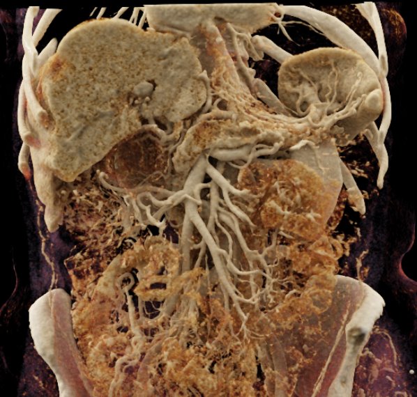 Pancreatic Adenocarcinoma with Cinematic rendering
