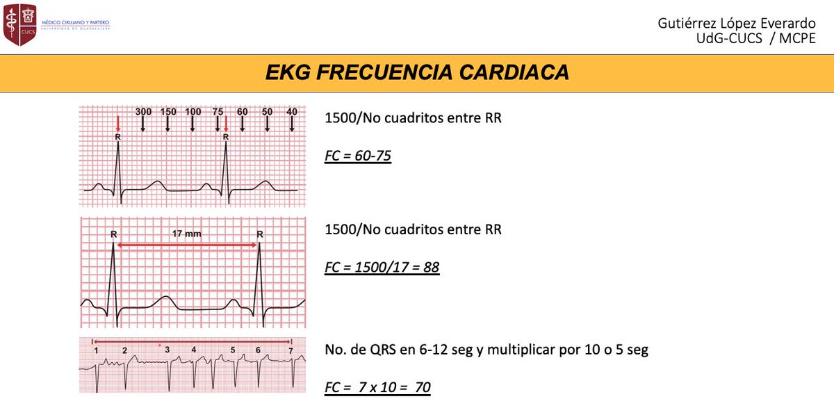 Eve Gutierrez Frecuencia Metodo1 1500 No Cuadritos Entre Rr Metodo 2 300 150 100 75 60 50 43 Metodo 3 No De Qrs En 6 12 Seg Y Multiplicar Por 10 O 5 Seg T Co Dfmjkmepia