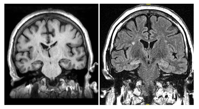 PMH: HTN and epilepsy. SH: No T/E/D. FH: no epilepsy. Meds: lisinopril, topiramate 75 mg, carbamazepine 1200 mg, zonisamide 400 mg, phenytoin 300 mg. No prior records or test results are available.Examination normal. 30 minute EEG awake and drowsy is normalMRI brain shown3/