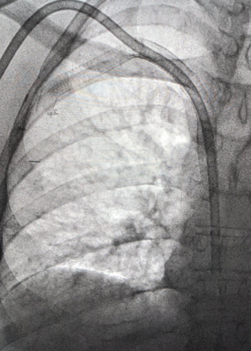 LessneVIR's tweet photo. Companion case:
Occluded COVERED stent across jugular vein. Pt dialyzing thru groin cath.
Direct stick stent graft, recanalize, & place dialysis cath thru interstices
#AlwaysOptions @CLTRadiology
#IRad
https://t.co/eeyZdX2HLu https://t.co/ojCcIfQejY