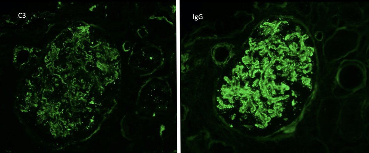 Thank you everyone for reading! Here are some pretty photos of membranous nephropathy.  Look out for my next  #Tweetorial!  #OncoNephrology  #MedEd  #FOAMed  #NSMC