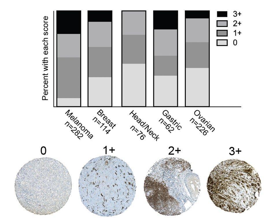 We looked within tumors ourselves using IHC and found that most tumors had at least punctate levels of IL-18BP expression (on macrophages), with many tumors showing extensive staining within tumor and stromal cells. (10/)