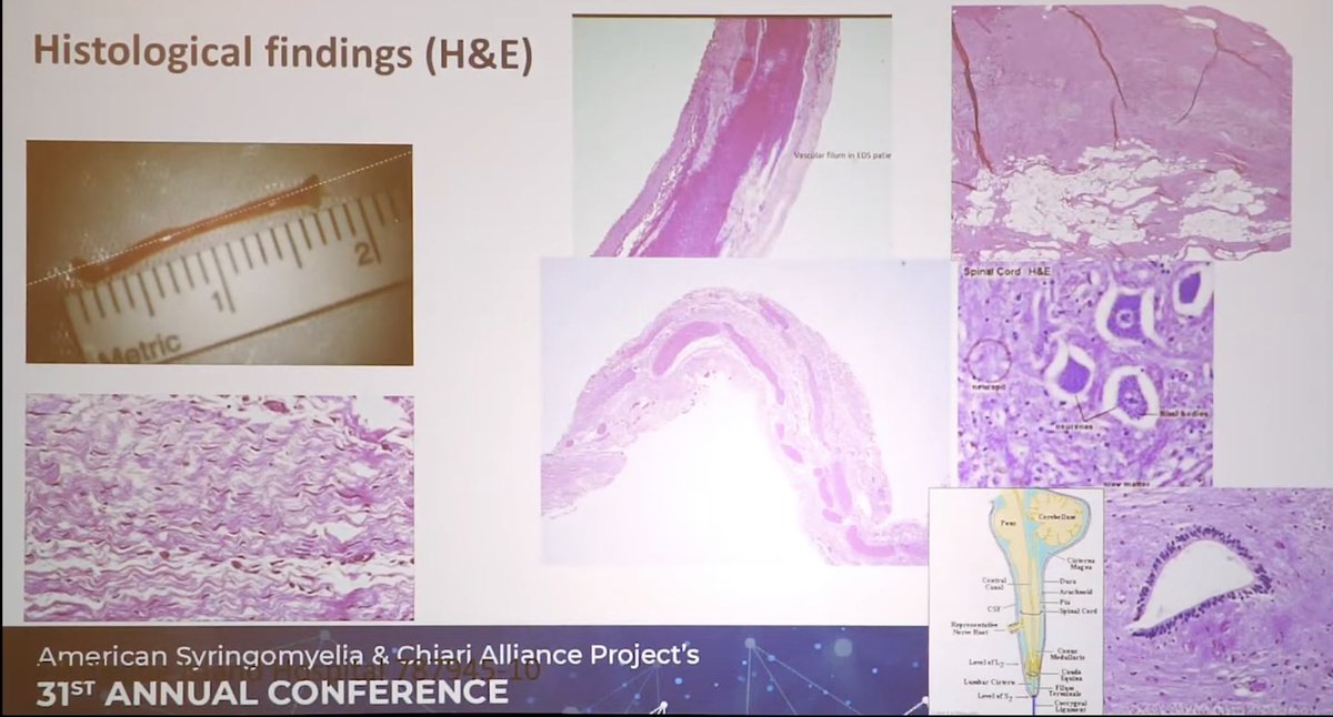 The results of Klinge’s histology studies of her 113 occult tethered cord syndrome patients are rich. She found venous abnormalities, collagen abnormalities, and *inflammatory changes* in her patient’s filums. [22]