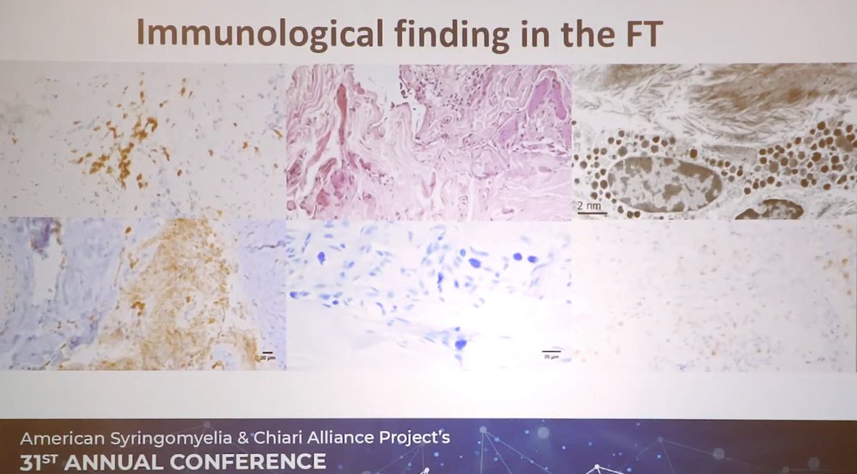 Klinge also found—and if you have  #MECFS, this may be a bit more your love language—major inflammatory changes: microglia in the filum, activated mast cells, CD45 lymphocytes. She wonders if this might be mirroring some kind of neuroinflammation happening in the spinal cord. [25]