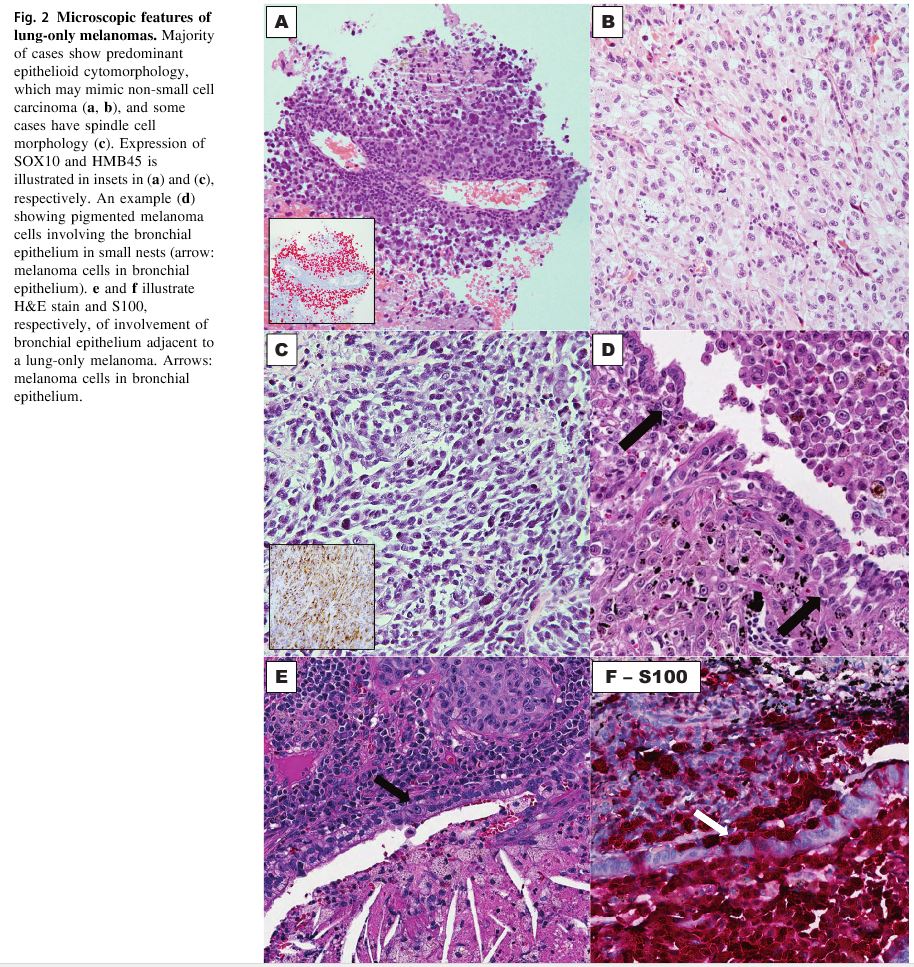 Super-important message for pathologists: solitary (even if very large) masses in the lung with no known primary ≠ lung carcinoma. Among other possibilities, DDx includes metastatic melanoma. These can be VERY epithelioid & can even stain for keratins . So watch out! 6/