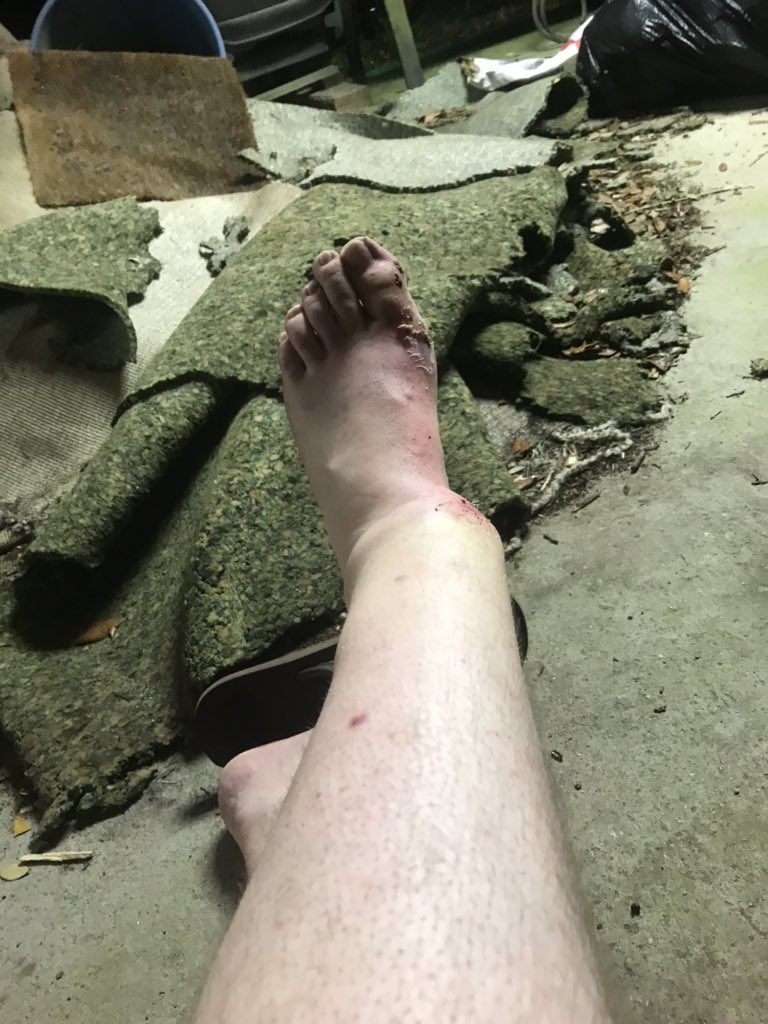 KILL BILL: THE RAPPER on Twitter: "TW: gross broken leg  https://t.co/cvvkp6wMxl" / Twitter