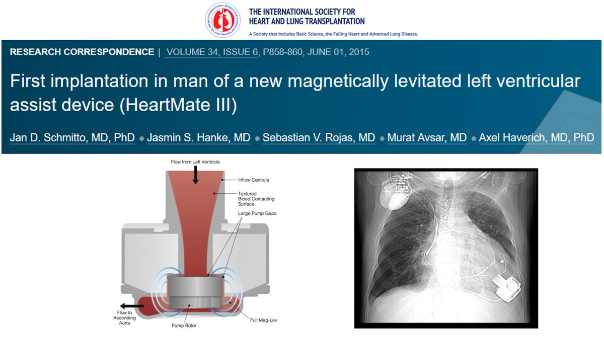 A day to remember : 25th of June 2014

The first implantation in man of a HeartMate 3 device !

It was 6 years ago in #Hannover

<a href="/JanSchmitto/">Jan D. Schmitto</a>

#EUMS_2020
#LVAD
#HeartFailure