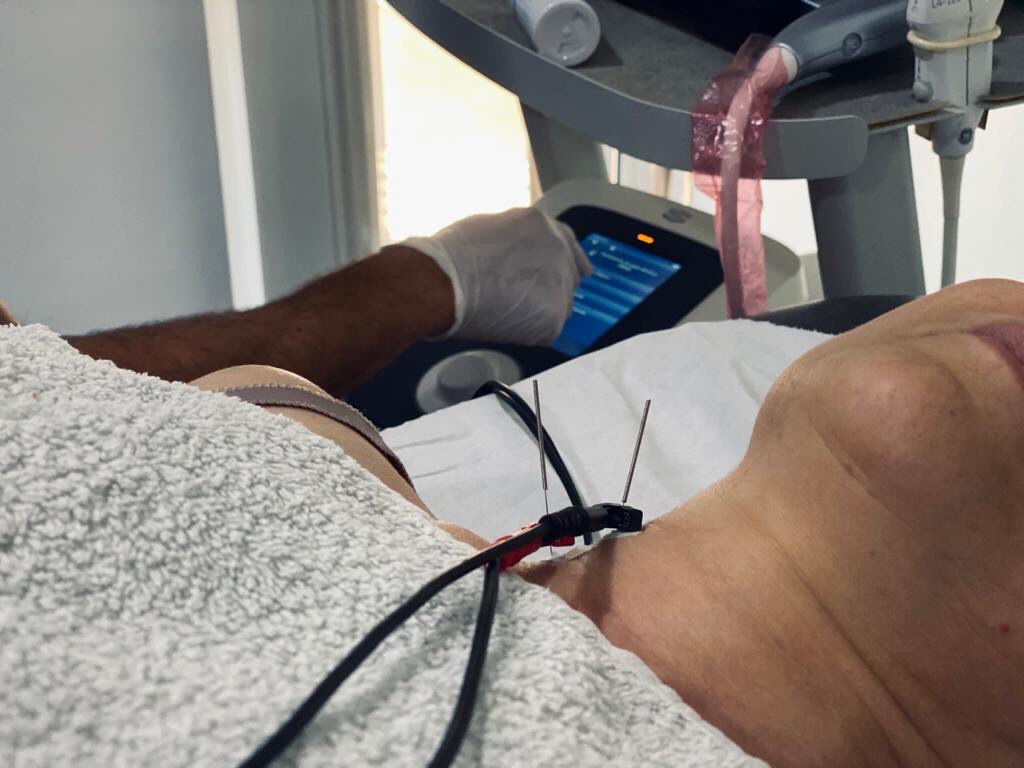 machofisio's tweet photo. Neuromodulacion del plexo braquial mediante campo electromagnético con equipos #emfieldzimmer y #endomed de ⁦@primfisio⁩. Estos abordajes mediante fisioterapia intervencionista siempre ecoguiados por la #seguridadclínica y la #especificidad Gracias al Logic R3 de GE. https://t.co/x53DkSHrjQ
