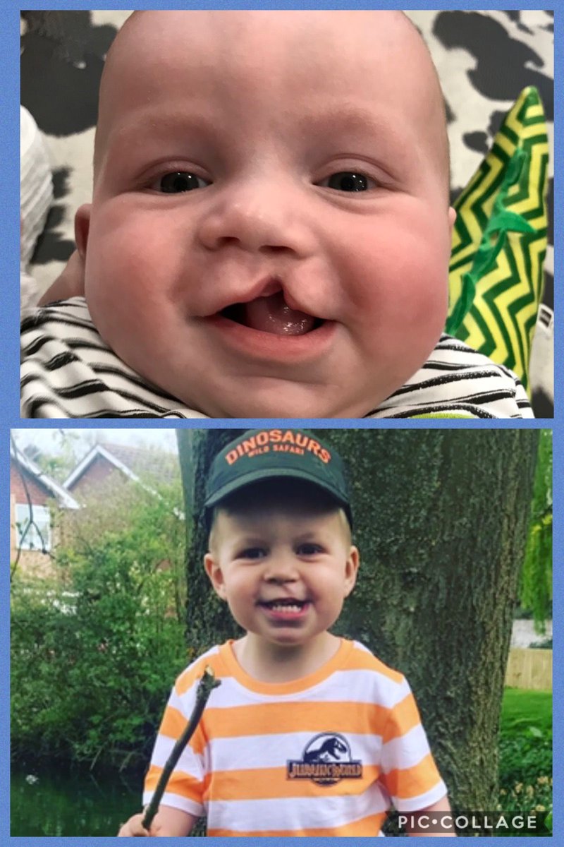 CLAPACOMMUNITY's tweet photo. ‘This is my son Ronnie the day before his operation at five months old and now at two years old...he is a true little fighter, nothing phases him and he is always showing everybody his incredible cheeky smile!’

Thank you for sharing, Leanne!

#DailySmile https://t.co/I0wQ9AiQyD
