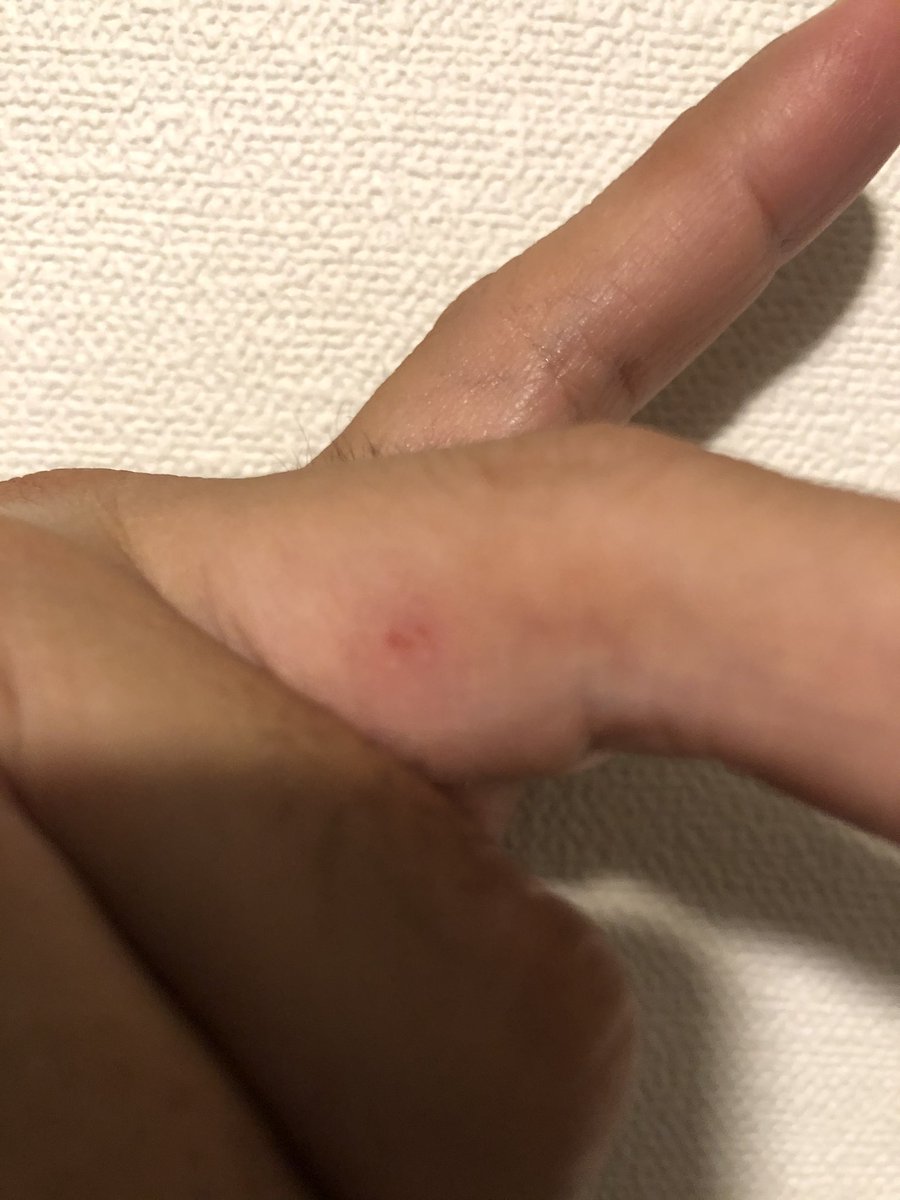 梅屋シン 釣り垢 Auf Twitter これってマダニとかじゃないですよね 釣りしてるときに何か痛いなぁと思って見たら 右手の中指と薬指の間にこんな跡が 普通に怪我的に水にしみたりするだけで痒くもなんともないけど 一応 何かに刺されたかもって 傷口は絞っ