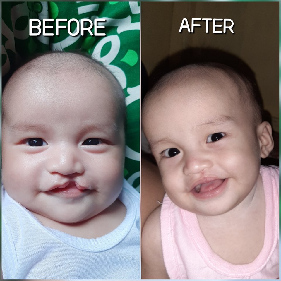 MabuhayDeseret's tweet photo. #TransformationThursday: Little Youzeff has a brighter and bigger smile, thanks to our partner @SmileTrainPh and donors like YOU who #worktogether with us to #makesomethingsweet 😃
#patientstories #cleftlip #cleftlipcutie #cleft #beforeandafter #smile https://t.co/GCQ3KFmWPP