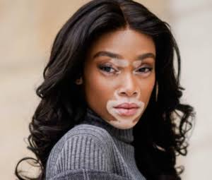 In VITILIGO there is a loss/absence of MELANOCYTES causing reduced melaninThe reduced melanin now causes whitish patches on the skin of the person.VITILIGO means a skin blemish that is non-contagious characterised by patches of skin discoloration caused by reduced melanocytes