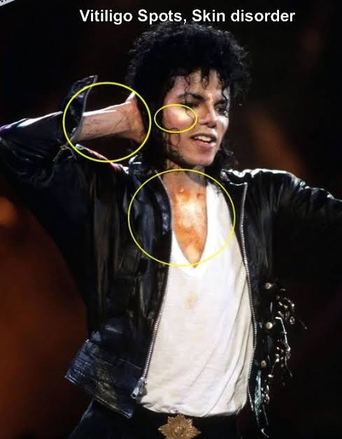 1n 1986 Micheal Jackson noticed white patches on his hand that was why he wore his famous glove...not as a fashion statement but to cover the patches...Patches started appearing on his face...So what CAUSED it...What Are The CAUSES Of VITILIGO?- The exact causes of...