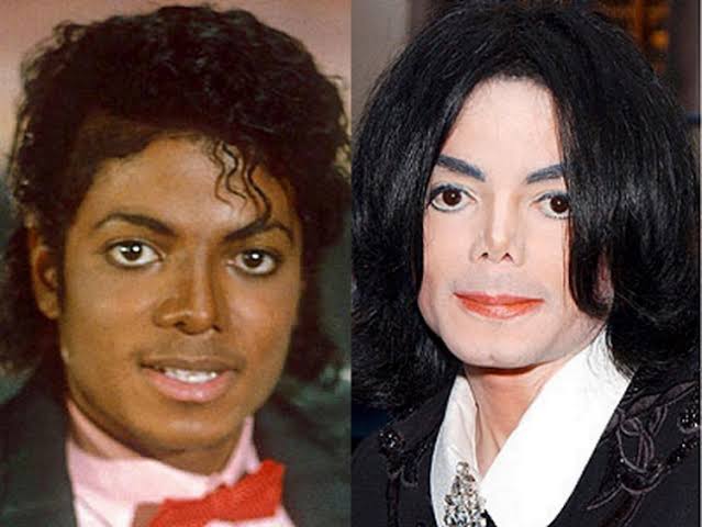 But when the patches become large and spreading all over the body...the following can be done;1. Skin Bleaching- This must be done under the guidance of a dermatologist (Skin Doctor/Specialist)...Micheal did this and his dermatologist,Dr. Arnold Klein confirmed it.