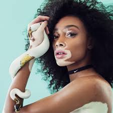 2. Skin Grafting- This is surgical replacement of the skin...This is extreme but people do it.Then you can decide to rock your God-given skin like that like Canadian fashion model WINNIE HALLOWAs we celebrate  #WorldVitiligoDay we need to stop the stigmatization...