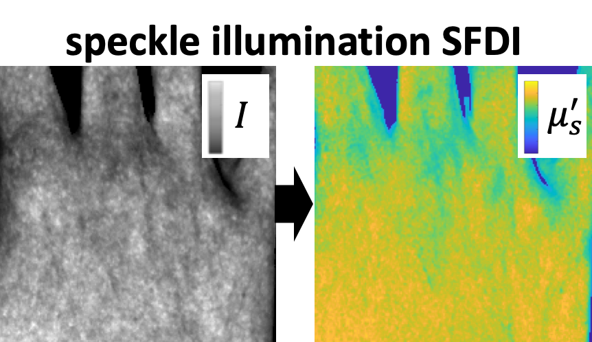 njdurr's tweet photo. Happy to present a new SFDI technique for widefield quantitative tissue imaging. We show that optical properties can be mapped by analyzing the blur of randomized speckle patterns https://t.co/z1iNlo4RRK https://t.co/1d5pnvqAK0