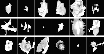 Radiology_AI's tweet image. Celebrating #ThrowbackThursday... Deep Radiogenomics of Lower-Grade Gliomas: Convolutional Neural Networks Predict Tumor Genomic Subtypes Using MR Images doi.org/10.1148/ryai.2… @MazurowskiPhD @DukeRadiology @DukeRAILabs #TBT #radiogenomics #LGG
