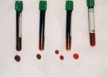 Human blood also occasionally takes on shades other than red, such as the greenish tinge of sulfhemoglobin or the chocolate-brown hue of methemoglobin (image: Medscape). I have seen plasma that is green due to drugs too, e.g. estrogens./10