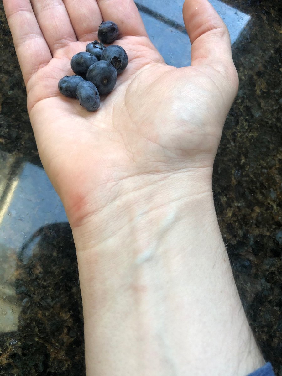 Some people do think venous blood is blue. They look at their wrists and see blue vessels (here's mine, with some blueberries for comparison). But that's an optical illusion reinforced by misleading schematics in textbooks, including Frank Netter's./14