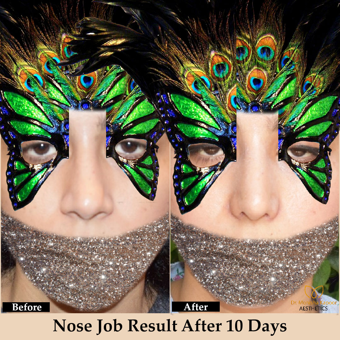 aestheticsdelhi's tweet photo. The results of rhinoplasty are long-lasting, and for that reason, you need to be sure exactly what you want before you have the procedure performed. 
More Info: +91- 9811439395, 8373984777, 8860851727 
#nosecontouring #nosetreatment #nosejobbeforeandafter #rhinoplastyspecialist https://t.co/0tjk1yEek3