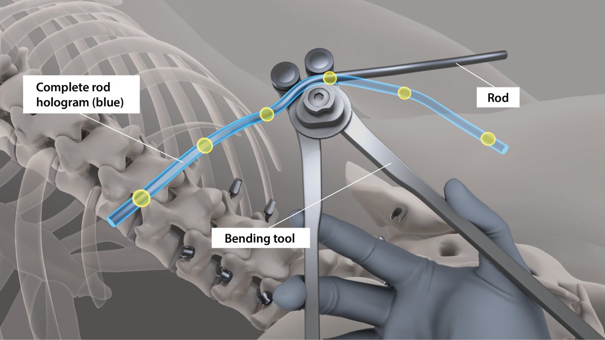 derbalgrist's tweet photo. ⚡An important step for #AugmentedReality technology in the operating room⚡Our team at #Balgrist has been working on a pioneering study with holographically navigated #SpineSurgery, together with @microsoft_ch @HoloLens @UZH_en @ETH_en 

👉🏻Learn more: https://t.co/aVR85TINDJ https://t.co/mPInEnAH7Y