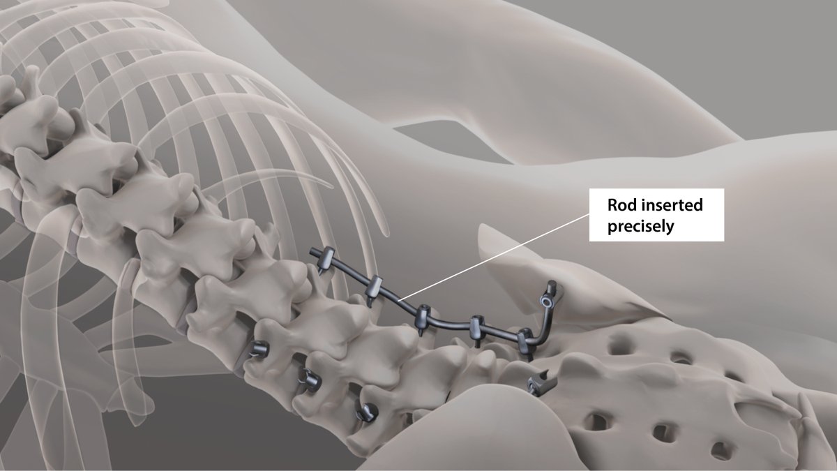 ⚡An important step for #AugmentedReality technology in the operating room⚡Our team at #Balgrist has been working on a pioneering study with holographically navigated #SpineSurgery, together with <a href="/microsoft_ch/">Microsoft Schweiz</a> <a href="/HoloLens/">Microsoft HoloLens</a> <a href="/UZH_en/">University of Zurich</a> <a href="/ETH_en/">ETH Zurich</a> 

👉🏻Learn more: bit.ly/3805zHd