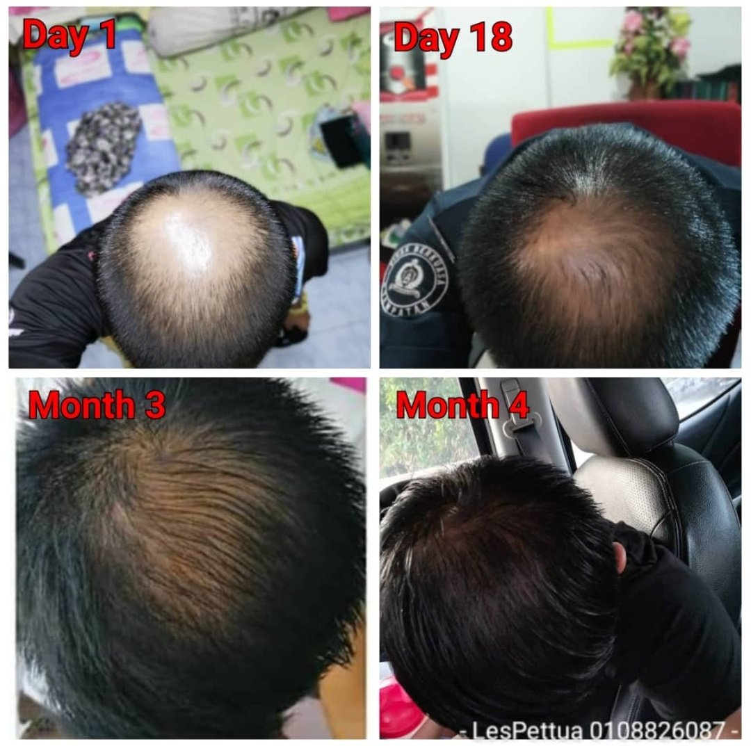 Dia cuba set pertama pada 28 Mac 2018.. 2 minggu selepas tu, dia pm sy tunjuk perubahan dekat rambut dia. Baru 2 minggu ni..Kalau tengok pd gambar ni, untuk dia, hanya ambil masa around 4 bulan je dah lebat macam ni.Lepas tu terus dia sign up nak jadi agent sy. Seronok dia.