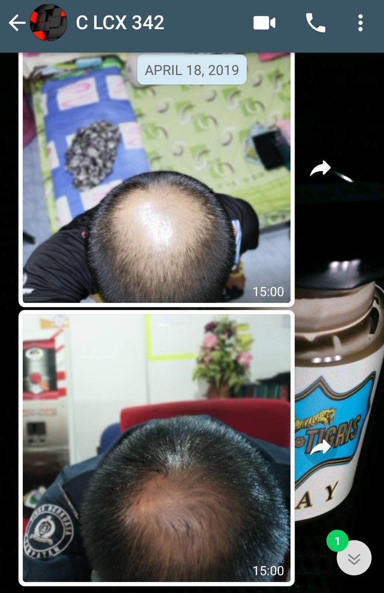 Dia cuba set pertama pada 28 Mac 2018.. 2 minggu selepas tu, dia pm sy tunjuk perubahan dekat rambut dia. Baru 2 minggu ni..Kalau tengok pd gambar ni, untuk dia, hanya ambil masa around 4 bulan je dah lebat macam ni.Lepas tu terus dia sign up nak jadi agent sy. Seronok dia.