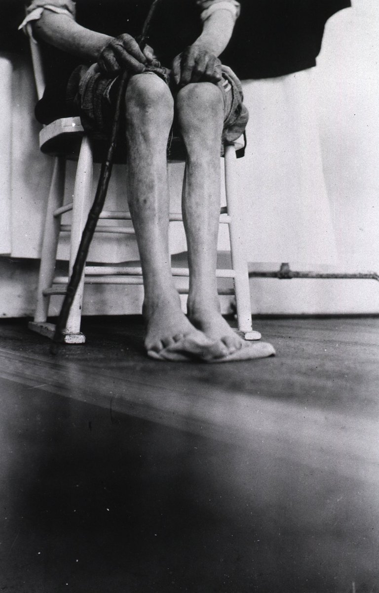 Male plague victim showing the effects of the disease on his legs, San Francisco, c.1907-09. #plague #bubonicplague #plaguearchives #sanfrancisco #early20thc #thirdplaguepandemic #ports #covid_19 #wasted #blackandwhitephotography #medicalphotography