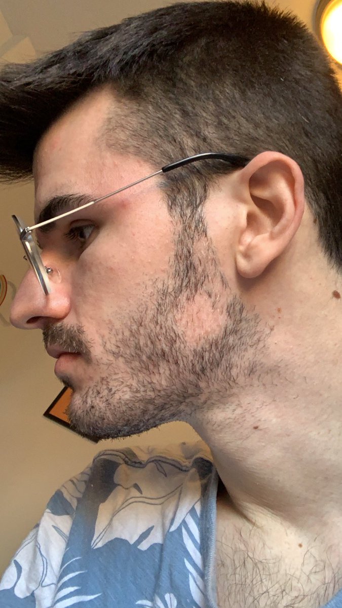 Vitiligo White Hair / Vitiligo As A Consequence Of The Use