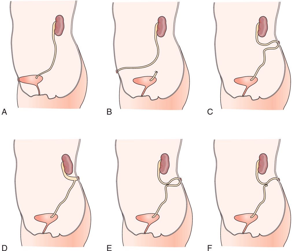 CirugiaPediaMx's tweet photo. Las variedades de derivaciones urinarias
✅ A. Vesicostomía
✅ B. Ureterostomía distal
✅ C. Ureterostomía proximal en asa
✅ D. Pielostomía cutánea
✅ E. Ureterostomía en anillo
✅ F. Ureterostomía en Y (Sober)

#SoMe4PedSurg 👶🏻 #Some4uroped #SoMe4Surgery https://t.co/EQqr82kHDN