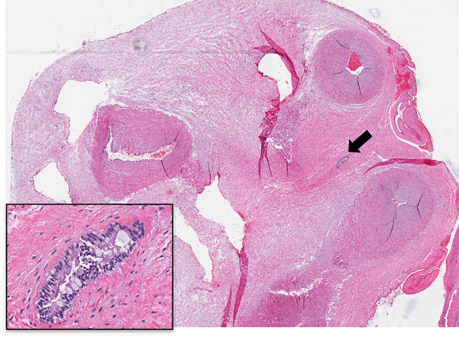 JonLaiMD's tweet photo. Found this cutie pie during my placenta rotation. Can anyone guess what it is? #pedspath #placenta #pathology #PGY1 #medstudent #pathoblast #cancernotcancer https://t.co/hUyWGrB8rL