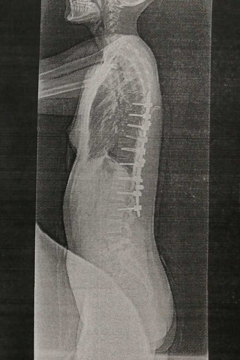 脊柱側弯症の後方固定術手術のビフォーアフターです。私の場合側弯は軽めだったんですが後弯がまぁまぁあることが認められたので手術をしました。どなたかの参考になれば。 