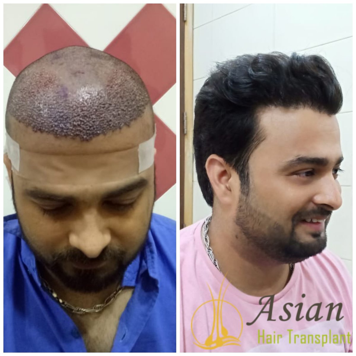 Asian Hair Transplant (@Asian_hair_) / Twitter