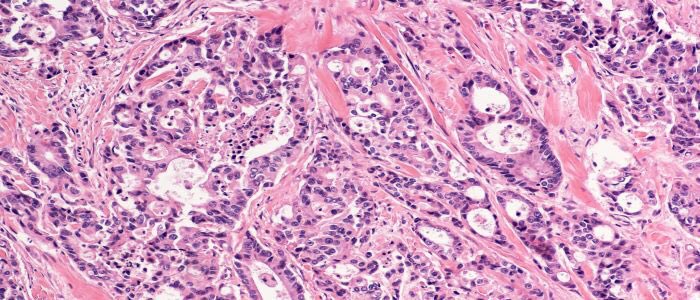 UofG MVLS (@uofgmvls) on Twitter photo 🆕 UofG, with <a href="/NHSGGC/">NHS Greater Glasgow and Clyde</a> & partners, is proud to announce it’s been awarded £2.3m from <a href="/UKRI_News/">UK Research and Innovation</a> to transform bowel cancer screening in #Scotland using an #AI #precisionmedicine tool. The INCISE project will improve cancer detection and reduce costs.
👉 ow.ly/fe6f30qVODx 🆕 UofG, with <a href="/NHSGGC/">NHS Greater Glasgow and Clyde</a> & partners, is proud to announce it’s been awarded £2.3m from <a href="/UKRI_News/">UK Research and Innovation</a> to transform bowel cancer screening in #Scotland using an #AI #precisionmedicine tool. The INCISE project will improve cancer detection and reduce costs.
👉 ow.ly/fe6f30qVODx