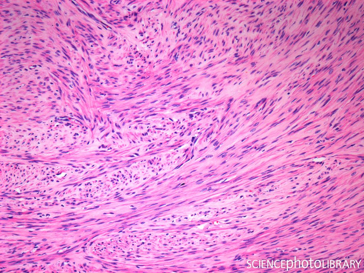 sciencephoto's tweet photo. Steve Gschmeissner used a light microscope to capture an image of uterine fibroids (leiomyoma), a benign tumour of fibrous and muscular tissue found in the wall of the uterus

C:Steve Gschmeissner/SPL
https://t.co/Dsn6EhK6hq
#uterus #science #microscopy #fibroids #lightmicrograph https://t.co/QHk5TLk8ZQ